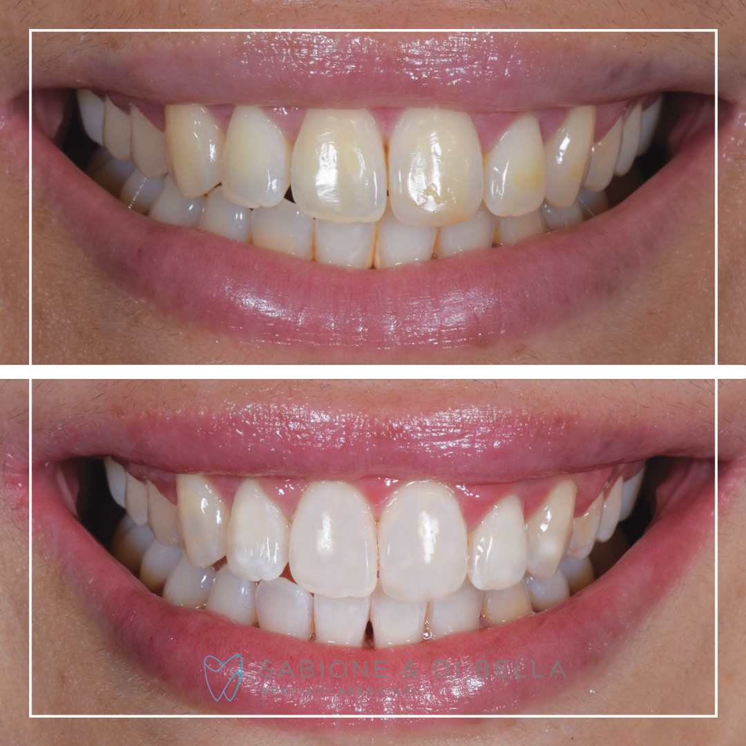 Foto prima e dopo di un paziente di dentista