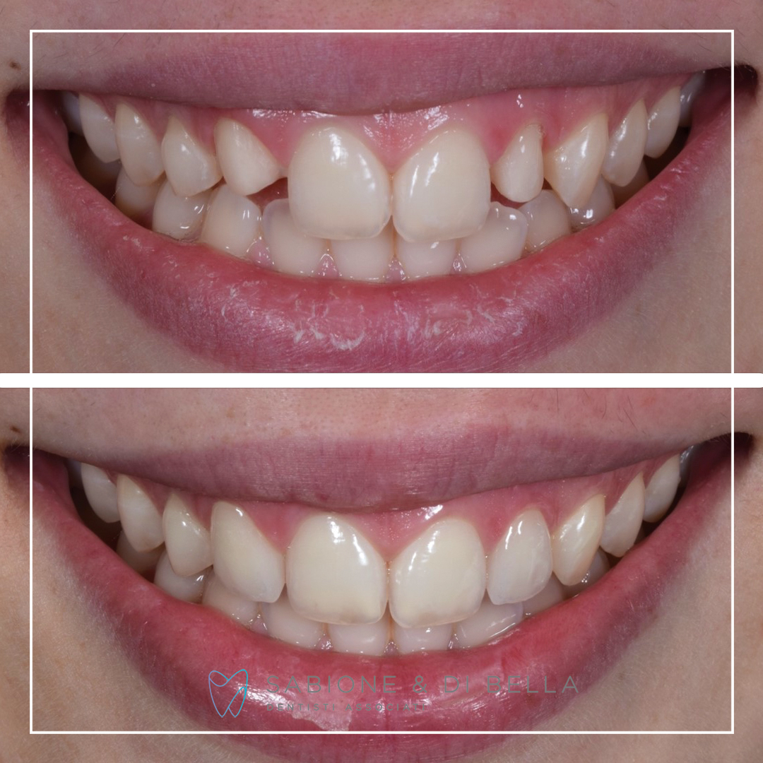 Foto prima e dopo di un paziente di dentista
