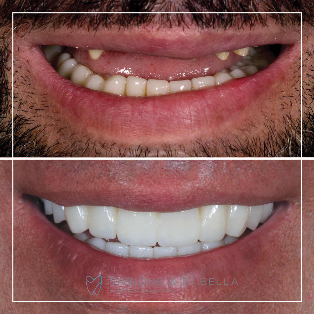 Foto paziente di dentista prima e dopo