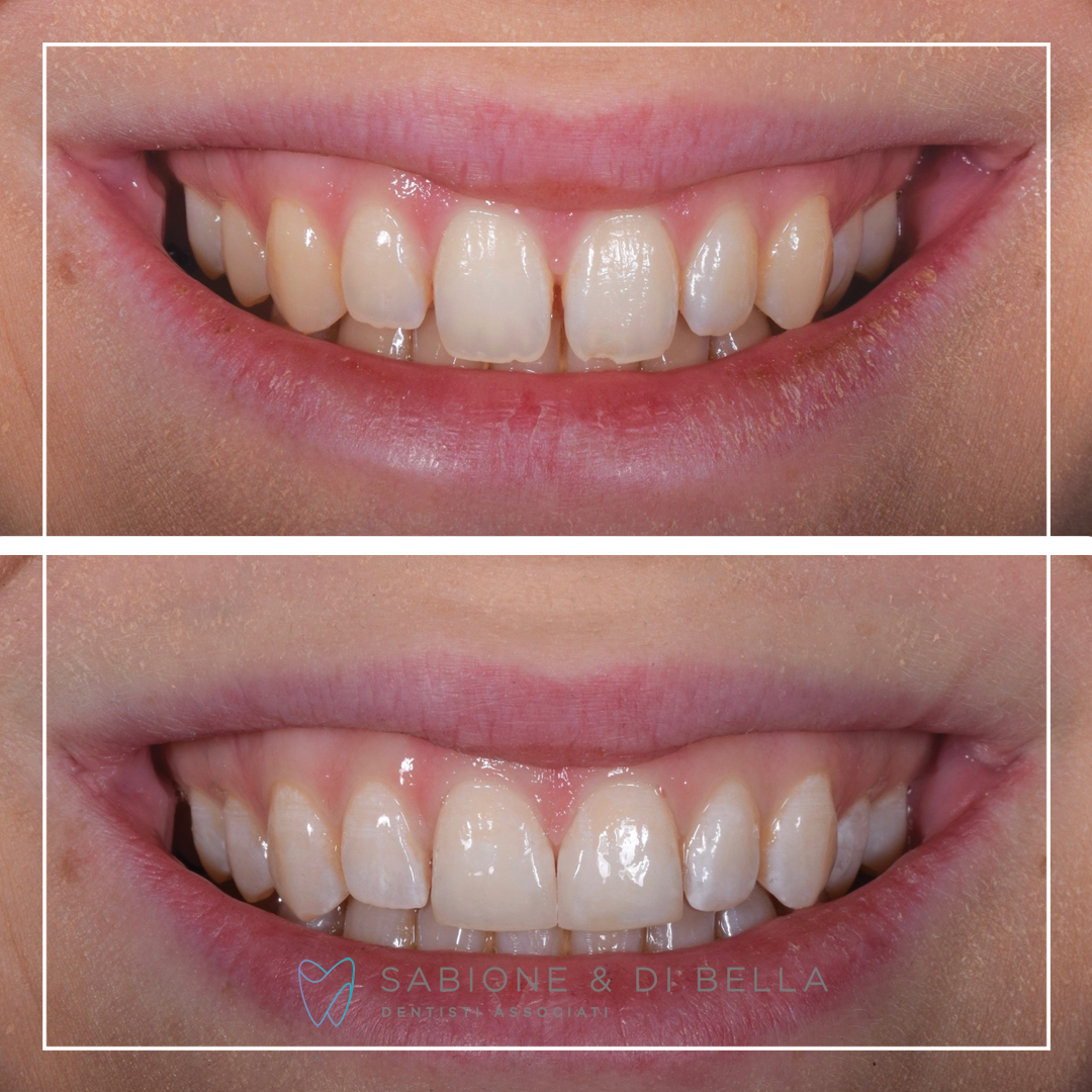 Immagine con prima e dopo di ricostruzione estetica dentale