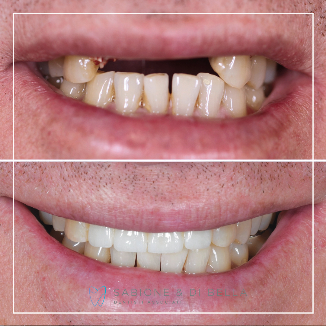 Foto di prima e dopo di un paziente di dentista