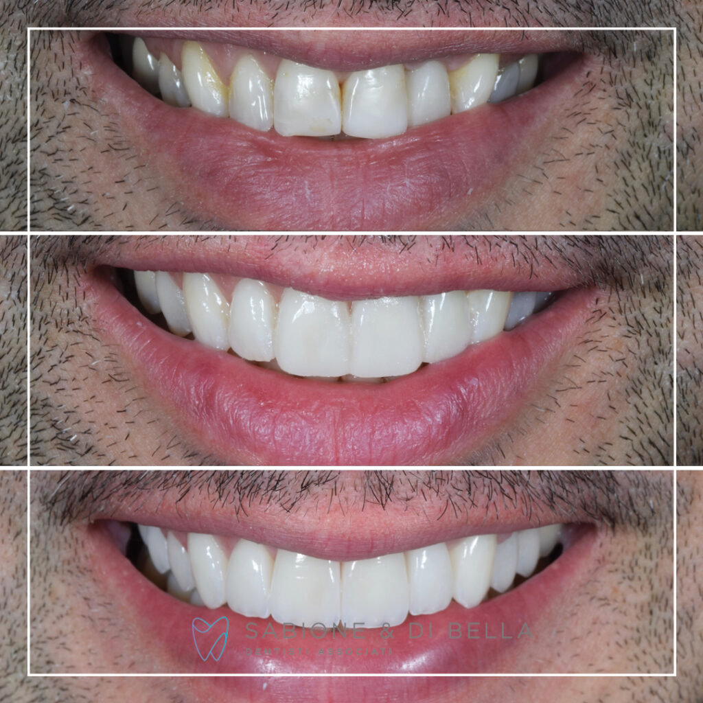 Mockup di Faccette estetiche in ceramica