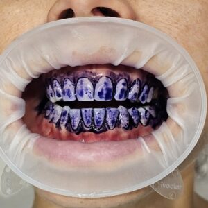 Rimozione biofilm