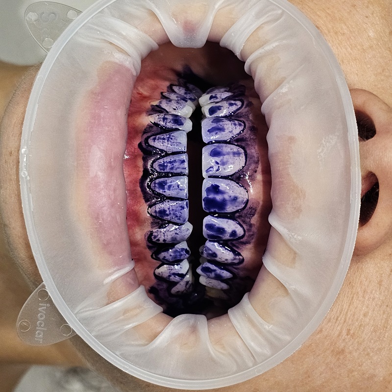 Rimozione biofilm