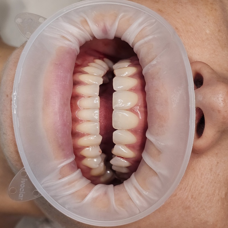 Pulizia dei denti